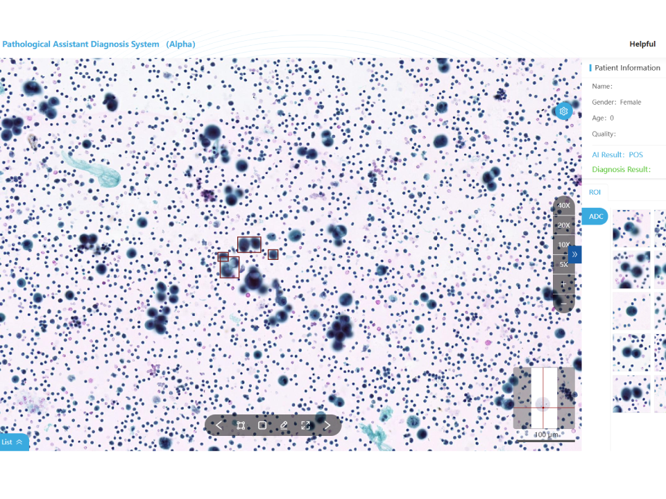 Hydrothorax and Ascites Cytology Assistant Diagnostic Module​